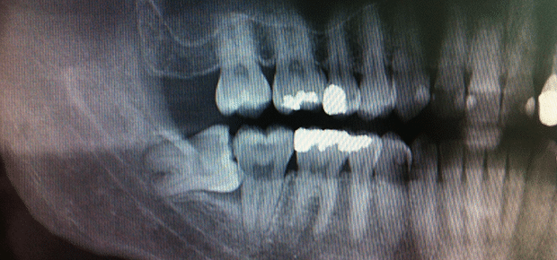 visdomstand eller visdomstænder i udbrud og kræver tandudtrækning hos en tandlæge til en fair pris eller på afbetaling