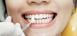 Tandblegning i Hørsholm på Sjælland giver dig smukke hvide tænder