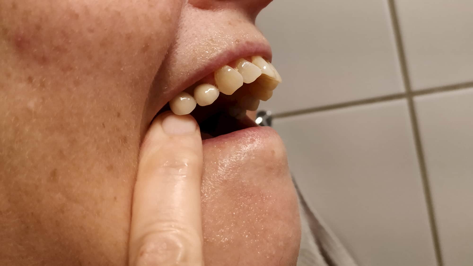 Double implantat lavet af tandlæge Hørsholm