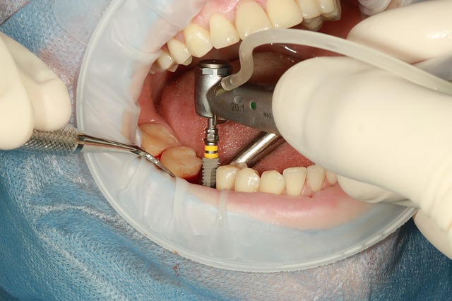 implantat som kan laves af tandlæge ved Holte og Birkerød