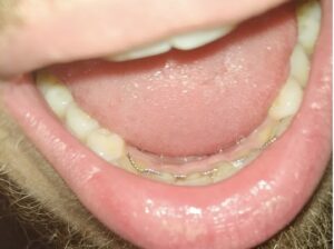 Metaltråd bag tænderne faldet af, som vi behandler hos tandlæge Kokkedal og Hørsholm