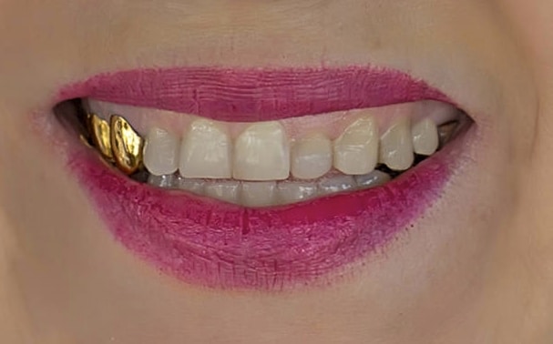 Få lavet en guldtand eller flere guldtænder hos en tandlæge. Det får du til en fair pris i Rungsted