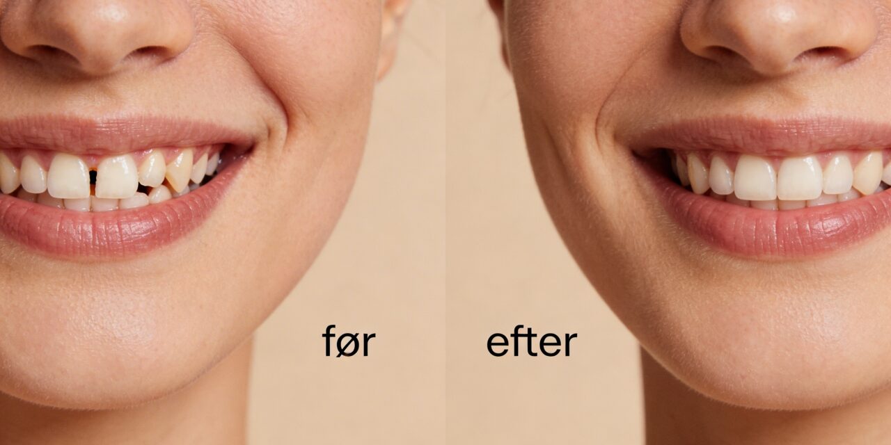 Composite Bondings: En omfattende guide til æstetisk tandbehandling