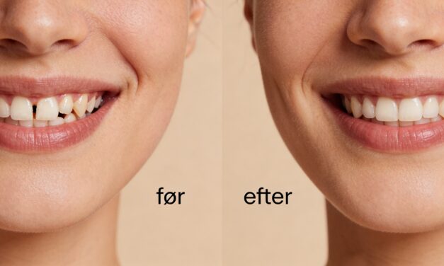 Composite Bondings: En omfattende guide til æstetisk tandbehandling