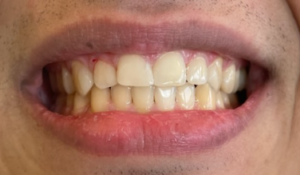 Billede af patient - efter - Composite Bondings