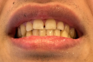 Billede af patient - før - Composite Bondings